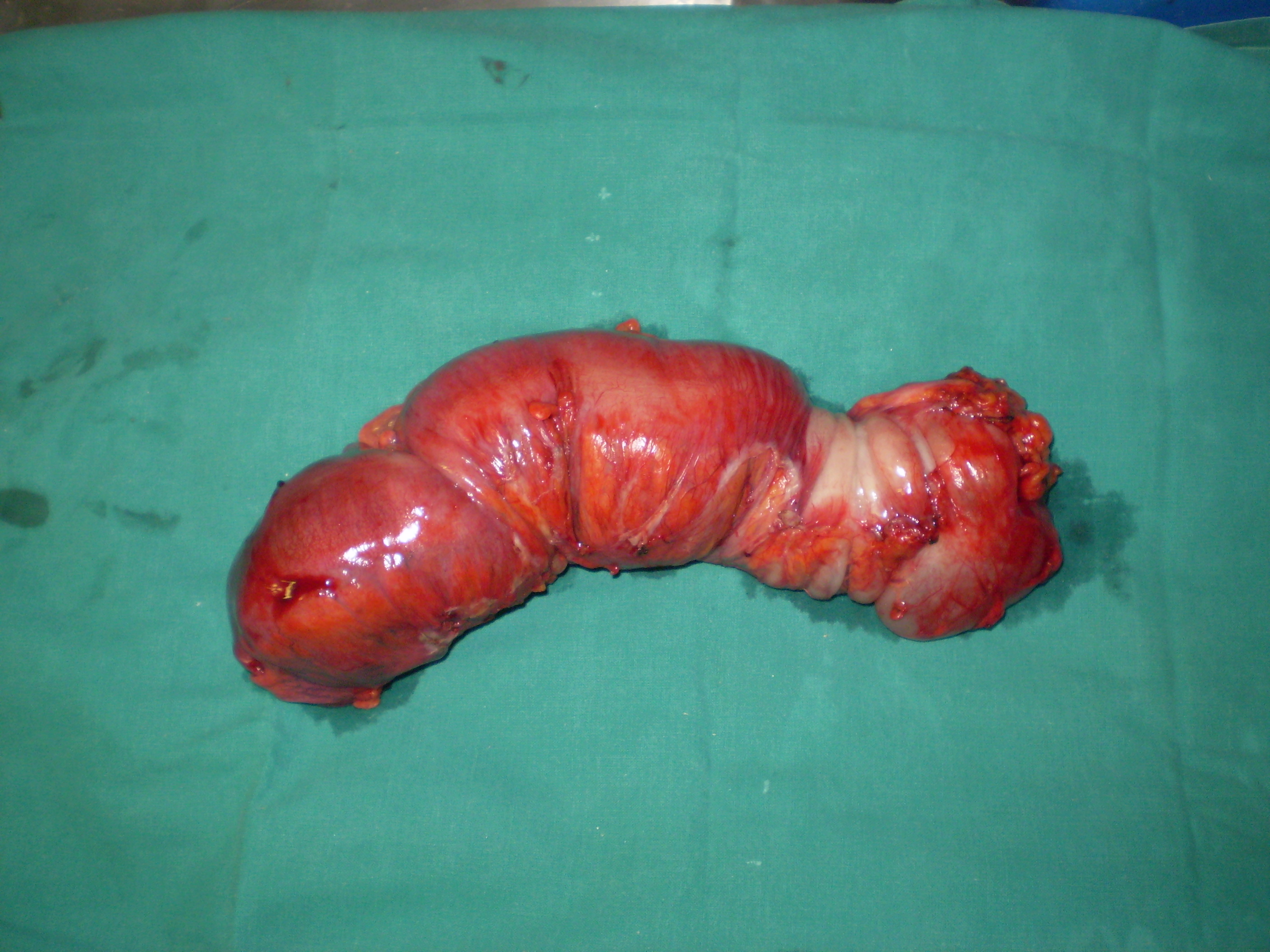 Εκτομνόμενο σάρκωμα (Ευγενική παραχώρηση Dr. V. Penopoulos)