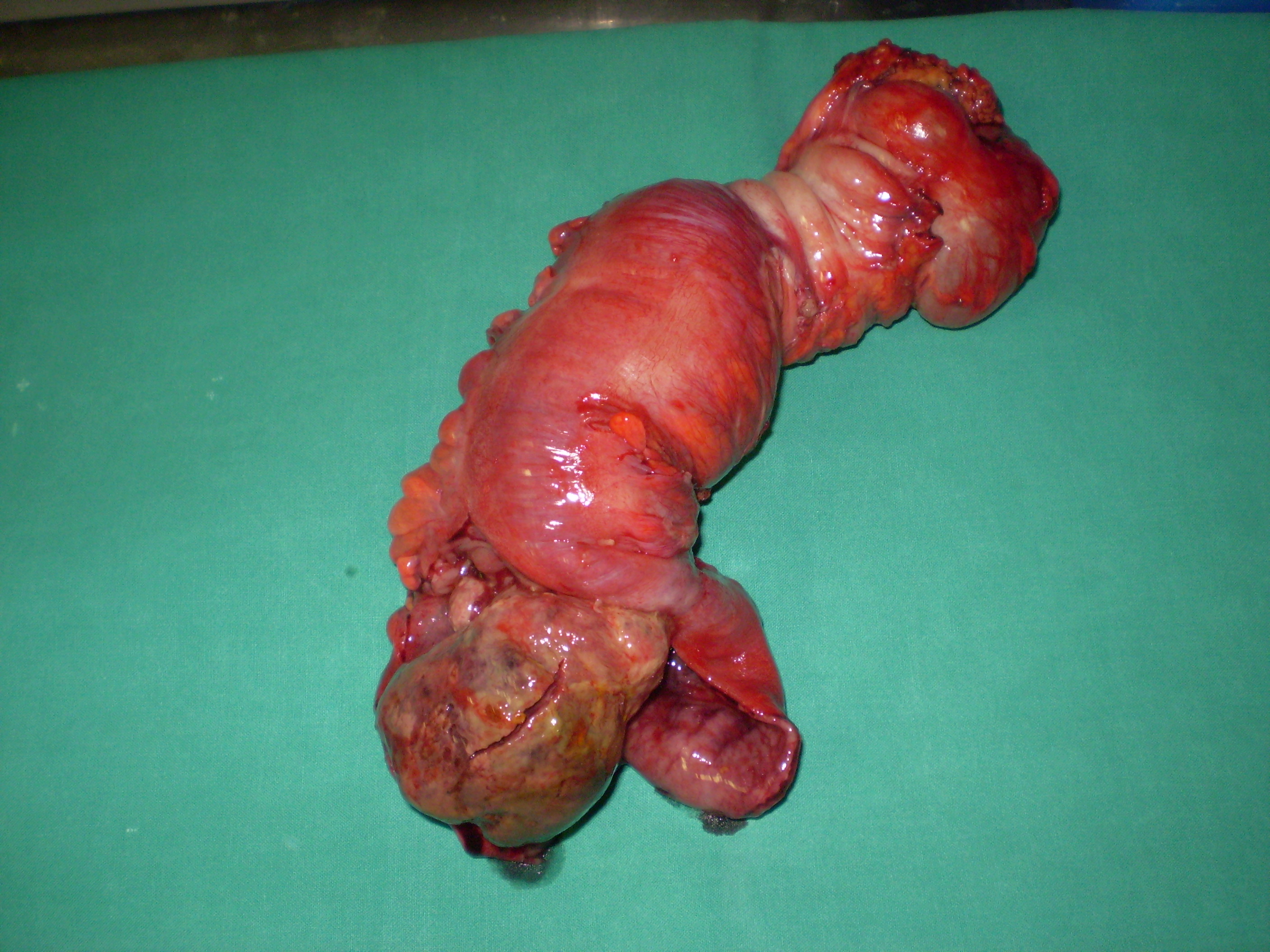 Εκτομνόμενο σάρκωμα (Ευγενική παραχώρηση Dr. V. Penopoulos)