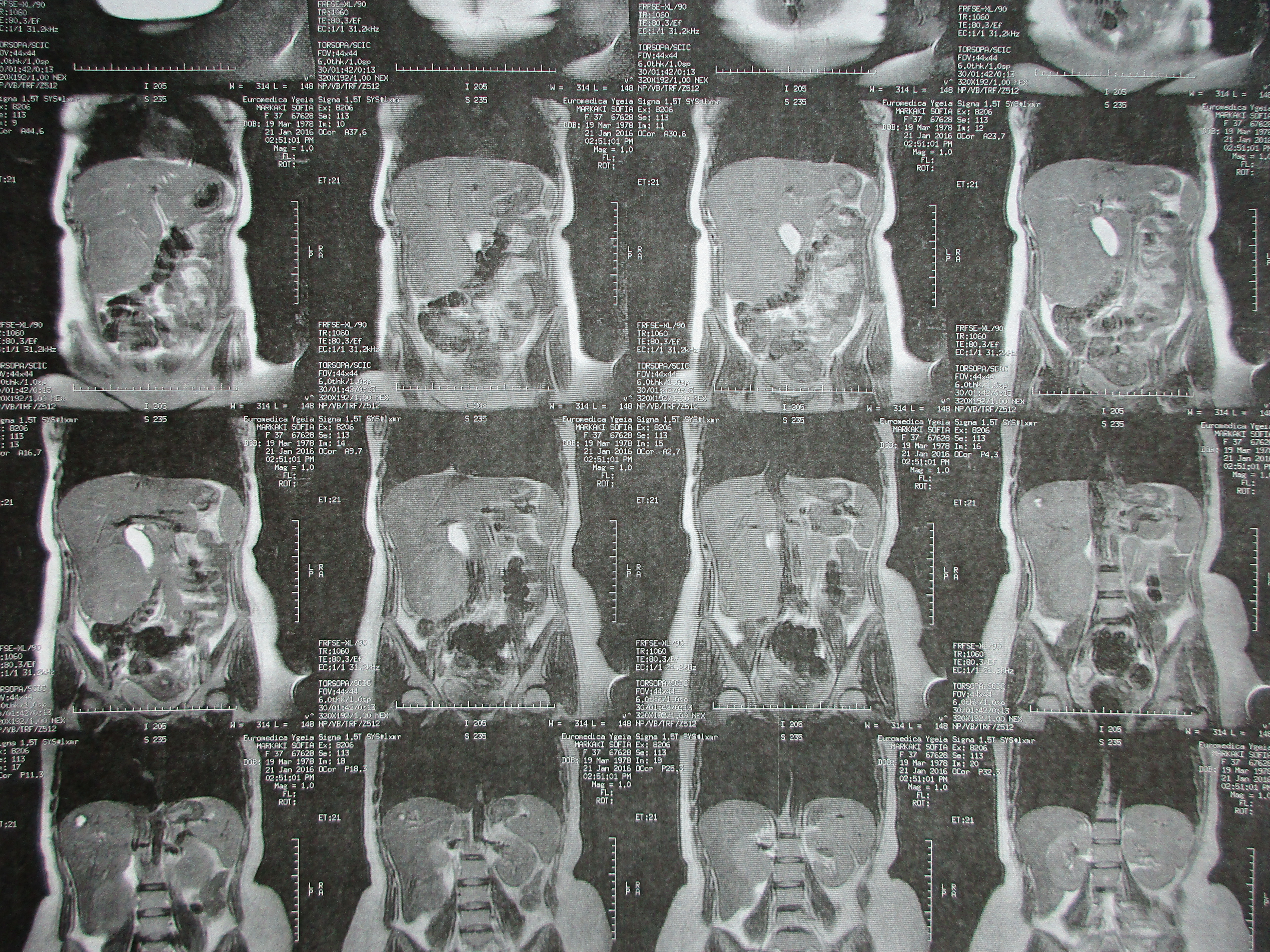 Διτμηματεκτομή ηπατικών δευτερογενών εστιών (Ευγενική παραχώρηση Dr. V. Penopoulos)