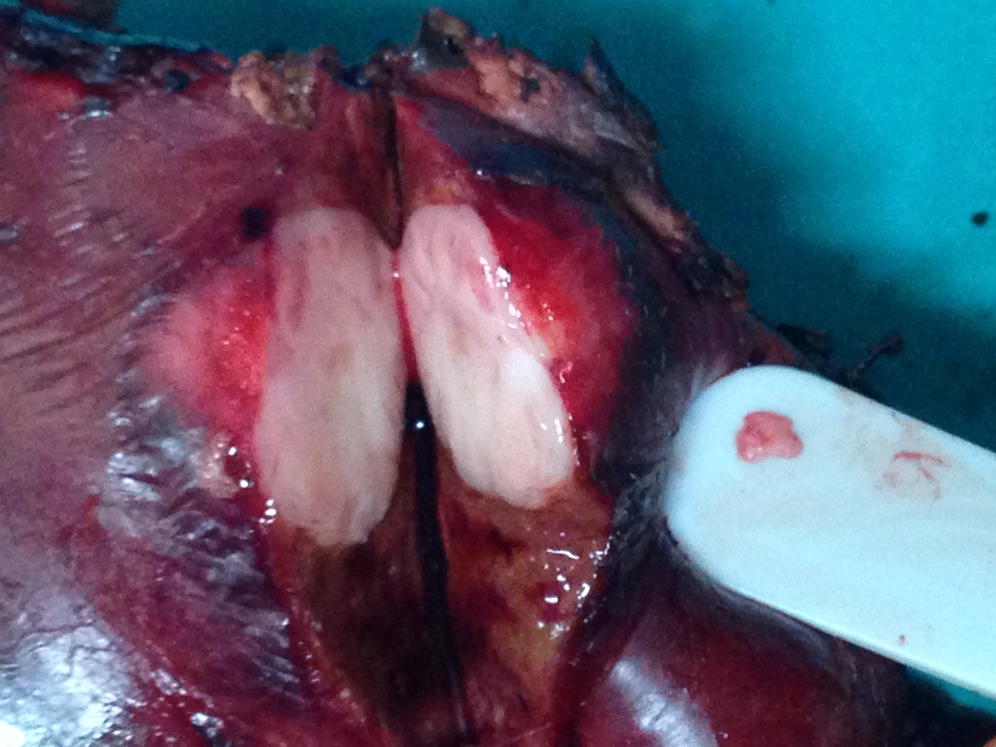 Εκτεμνόμενες ηπατικές μεταστάσεις (Ευγενική παραχώρηση Dr. V. Penopoulos)