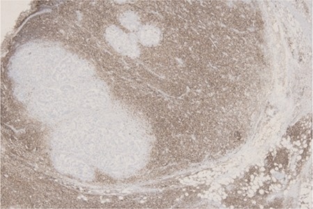 Το αποφρακτικό αδενοκαρκίνωμα του εγκάρσιου κόλου (Ευγενική παραχώρηση Dr. V. Penopoulos)