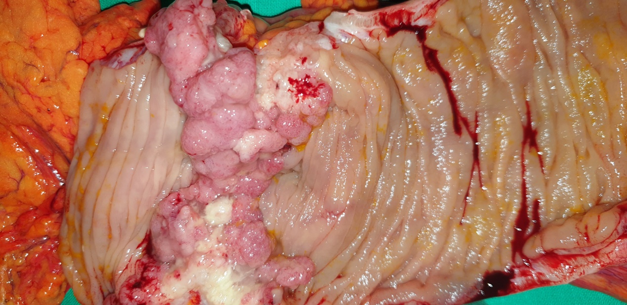 Το αποφρακτικό αδενοκαρκίνωμα του εγκάρσιου κόλου (Ευγενική παραχώρηση Dr. V. Penopoulos)