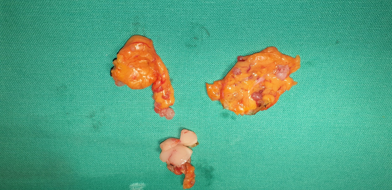 Διηθημένοι λεμφαδένες με καρκινικά και άτυπα λεμφοκύτταρα (Ευγενική παραχώρηση Dr. V. Penopoulos)