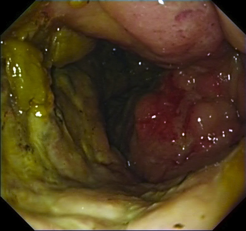 Διηθημένοι λεμφαδένες με καρκινικά και άτυπα λεμφοκύτταρα (Ευγενική παραχώρηση Dr. V. Penopoulos)