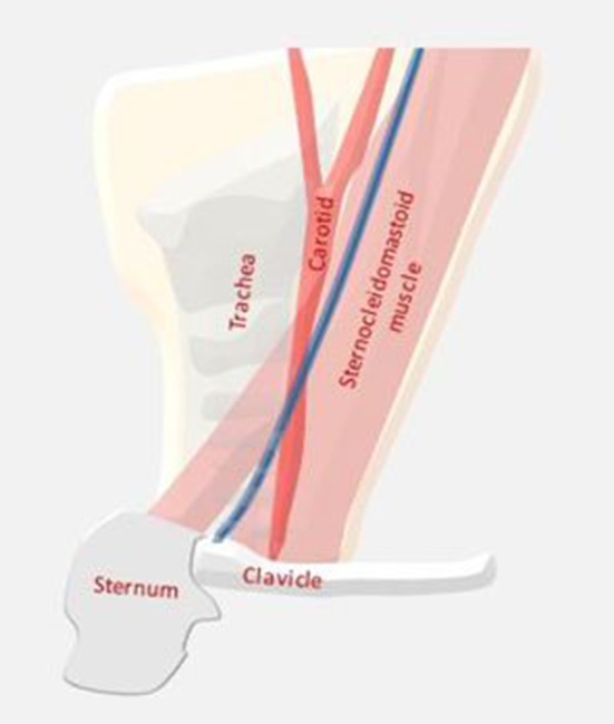 2nd branchial cleft cyst (Courtesy Dr. V. Penopoulos)