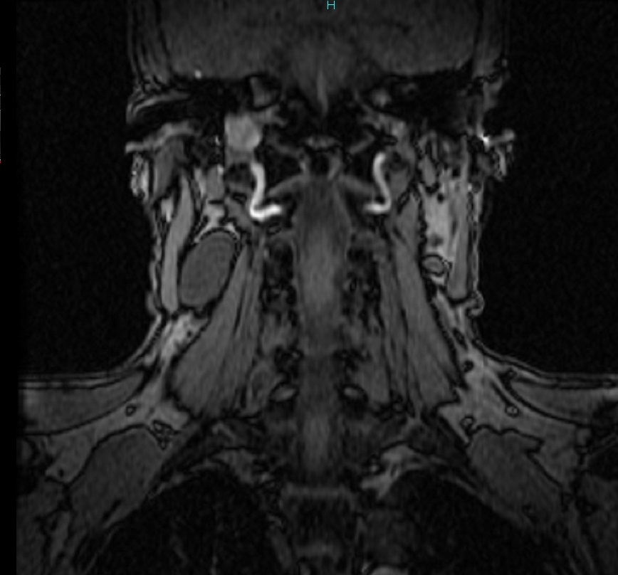 2nd branchial cleft cyst (Courtesy Dr. V. Penopoulos)