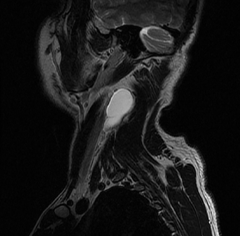 2nd branchial cleft cyst (Courtesy Dr. V. Penopoulos)