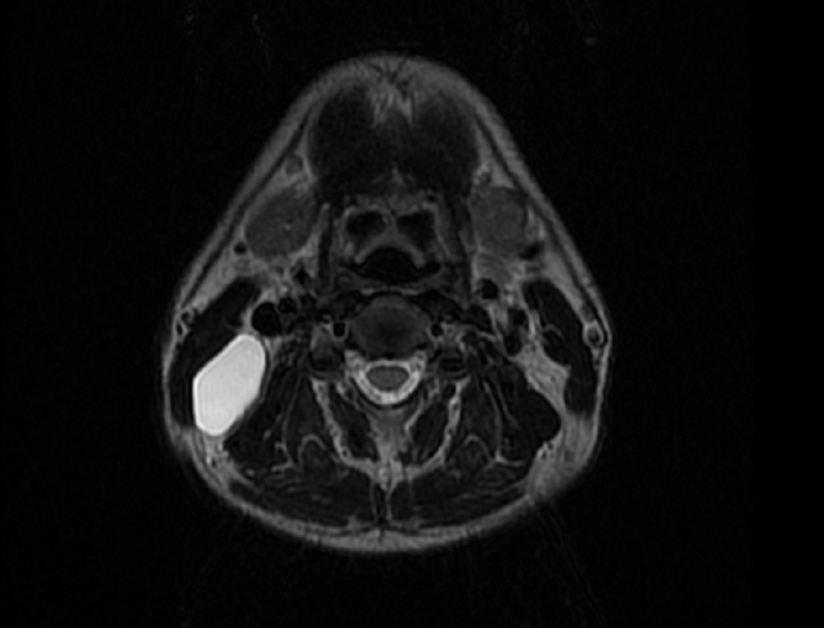 2nd branchial cleft cyst (Courtesy Dr. V. Penopoulos)