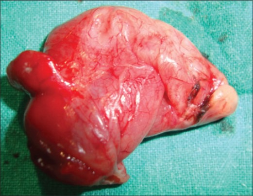 Gross examination of the excised cyst reveals a smooth surface lining of uniform thickness without papillary projections (Courtesy Dr. V. Penopoulos)