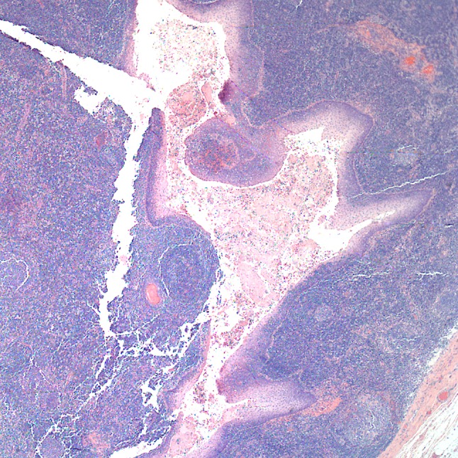 Gross examination of the excised cyst reveals a smooth surface lining of uniform thickness without papillary projections (Courtesy Dr. V. Penopoulos)