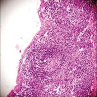 Gross examination of the excised cyst reveals a smooth surface lining of uniform thickness without papillary projections (Courtesy Dr. V. Penopoulos)