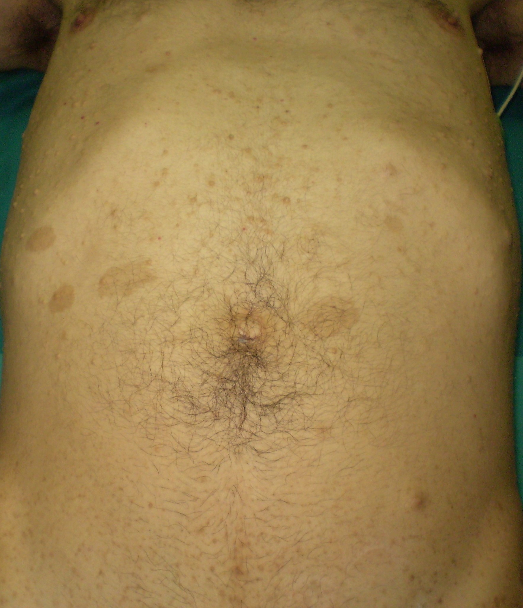 Bleeding jejunal GIST (Courtesy Dr. V. Penopoulos)