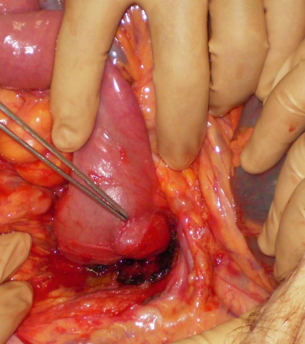 Non bleeding jejunal GIST (Courtesy Dr. V. Penopoulos)