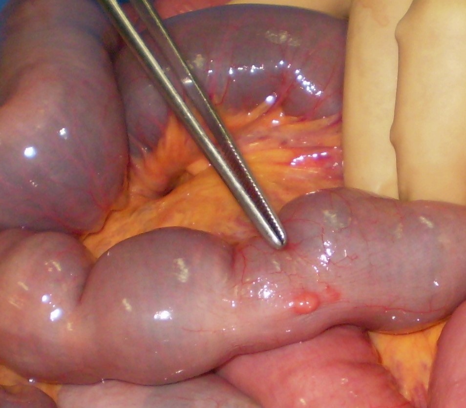 Non bleeding jejunal GIST (Courtesy Dr. V. Penopoulos)