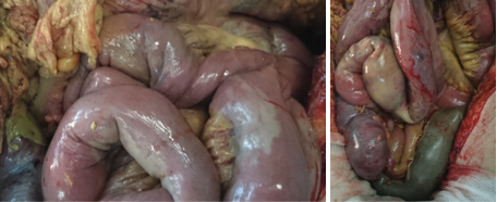 Bowel Ischaemic changes
