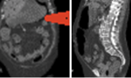 CT Scan: Gastric pneumatosis (red arrow)