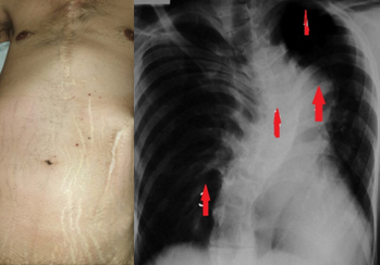 Σχήμα 4,5 . Pectus excavatum , striae atrophicae και προεξέχουσα σκολίωση . (Ευγενική παραχώρηση Δρ. Β. Πενόπουλος) .