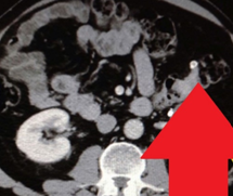 Σχήμα 1 . Η αξονική τομογραφία με ενισχυμένη με σκιαγραφικό έδειξε μια ακανόνιστη περιφερική μάζα στο αριστερό μισό του εγκάρσιου κόλου με λιπώδη συσσωμάτωση δίπλα σε παχυσμένο τοίχωμα του εντέρου. ( Ευγενική παραχώρηση Δρ. Β. Πενόπουλος ) .