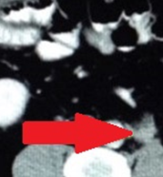 Σχήμα 5 . Η αξονική τομογραφία έδειξε μια οπισθοπεριτοναϊκή μάζα που περιβάλλει τον αριστερό οσφυϊκό ουρητήρα και προκαλεί ουρητηρο-υδρονέφρωση: Η βλάβη αυτή υποδηλώνει υποτροπή . ( Ευγενική παραχώρηση Δρ. Β. Πενόπουλος ) .