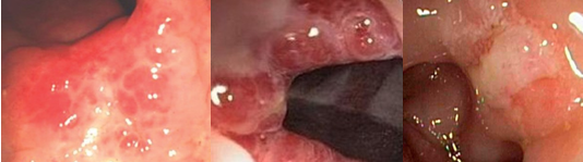 Σχήμα 1 . Μοναχικά έλκη του ορθού (ευγενική παραχώρηση Δρ. Β. Πενόπουλος) .