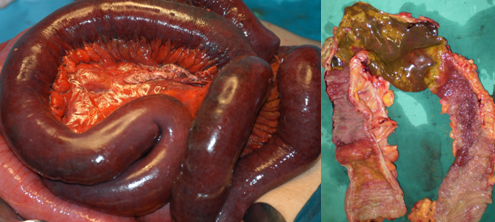 Figure 3 . Intestinal  ischemia . ( Courtesy   Dr . V . Penopoulos ) .