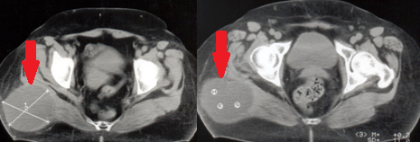 Σχήμα 1 . Αξονική τομογραφία . Ογκώδης όγκος στον δεξιό γλουτό . ( Ευγενική παραχώρηση Δρ. Β. Πενόπουλος ) .