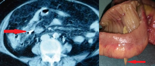 Figure 1 . Bone   fragment   penetrating   the   bowel   wall . ( Courtesy  Dr . V . Penopoulos ) .