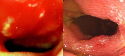 Figure 1 . Ileal  ulcers . ( Courtesy  Dr . V . Penopoulos ) .