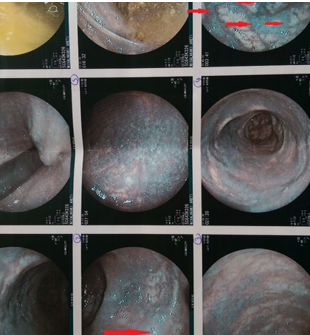 Σχήμα 1 . Διακρίνονται καθαρά οι υποβλεννογόνιοι κιρσοί του ορθού . ( Ευγενική παραχώρηση Δρ . Β . Πενόπουλος ) .