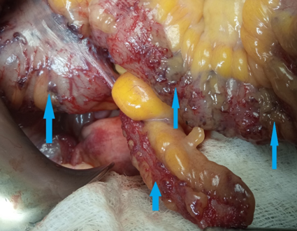 Σχήμα 3 . Υποβλεννογόνιοι ειλεοκολικοί κιρσοί χωρίς σημασία . ( Ευγενική παραχώρηση Δρ. Β. Πενόπουλος ) .  