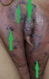 Σχήμα 4 . Κιρσοί αιδοίου και κλειτορίδας . ( Ευγενική παραχώρηση Δρ. Β. Πενόπουλος ) .