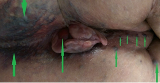 Σχήμα 5 . Οσφυϊκή περιοχή και περιπρωκτικοί κιρσοί μαζί με πρόπτωση αιμορροΐδων πριν από τη χειρουργική επέμβαση . Δεν εντοπίστηκε καμία ανωμαλία στα λαγόνια αγγεία . (Ευγενική παραχώρηση Δρ. Β. Πενόπουλος) .