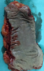 Σχήμα 6 . Το ορθό που έχει αφαιρεθεί (ευγενική παραχώρηση Δρ. Β. Πενόπουλος) .