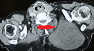 Σχήμα 1 . Η μαγνητική τομογραφία έδειξε μια καλά περιγεγραμμένη βλάβη με κυρίαρχη ένταση σήματος ισοδύναμου με το λίπος . ( Ευγενική παραχώρηση Δρ . Β . Πενόπουλος ) .