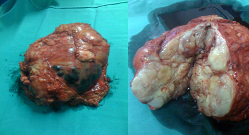 Σχήμα 2 . Κομμένη επιφάνεια του όγκου που αφαιρέθηκε (Ευγενική παραχώρηση Δρ. Β. Πενόπουλος) .