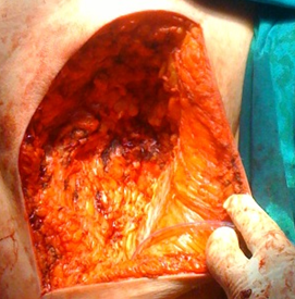 Σχήμα 3 . Είναι εμφανής η πλήρης εκτομή του όγκου . ( Ευγενική παραχώρηση Δρ. Β. Πενόπουλος ) .