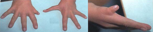 Σχήμα 1 . Τυπικές δυσπλασίες των χεριών του συνδρόμου Holt Oram . ( Ευγενική παραχώρηση Δρ. Β. Πενόπουλος ) .