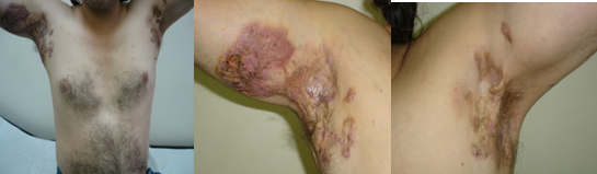 Σχήματα 1 , 2 , 3 . Hidradenitis suppurativa . ( Ευγενική παραχώρηση Δρ. Β. Πενόπουλος ) .