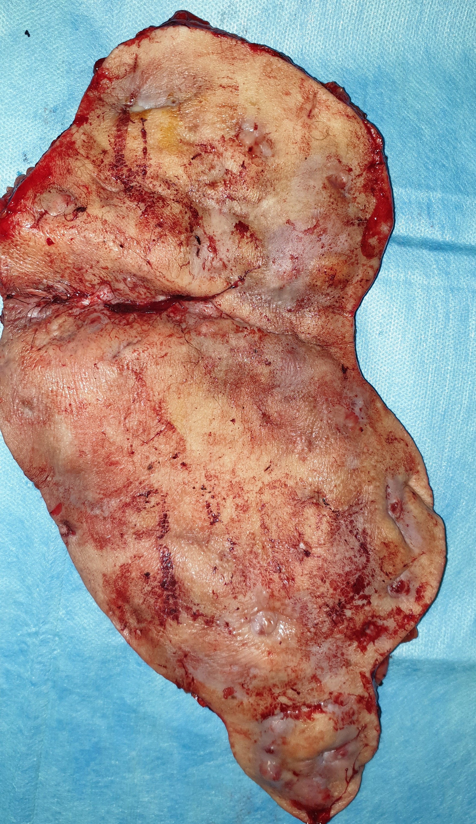 Σχήμα 6. Εξαιρούμενη μασχαλιαία νόσος. (Ευγενική παραχώρηση Δρ.)