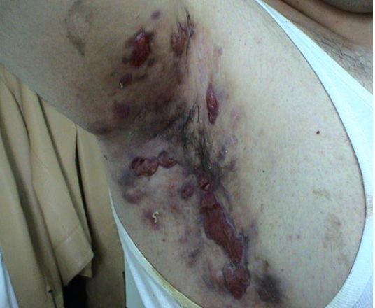 Σχήμα 4 . Πυώδης κρυοδερματίτιδα. (Ευγενική παραχώρηση Δρ. Β. Πενόπουλος) .