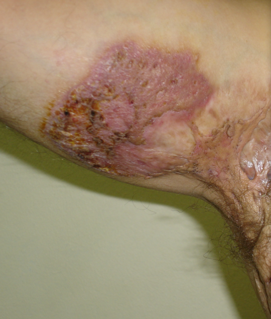 Σχήμα 5 . Πυώδης κρυοδερματίτιδα. Αποστήματα , παροχετευτικά ιγμόρεια και ουλές . (Ευγενική παραχώρηση Δρ . Β . Πενόπουλος ) .