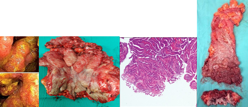 Σχήμα 1 . Γιγαντιαίο λαχνώδες αδένωμα που αφαιρέθηκε πλήρως με AP εκτομή . ( Ευγενική παραχώρηση Δρ. Β. Πενόπουλος ) .
