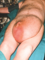 Σχήμα 2 . Γιγαντιαία βουβωνοκήλη , που εκτείνεται μέχρι την άρθρωση του γόνατος (ευγενική παραχώρηση Δρ. Β. Πενόπουλου) .