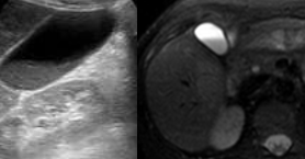 Figure 2.Thickened gallbladder wall and presence of biliary sludge.(Courtesy Dr.V.Penopoulos).