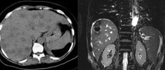 Figure 4.Multiple hepatic abscesses.(Courtesy DR.V.Penopoulos).