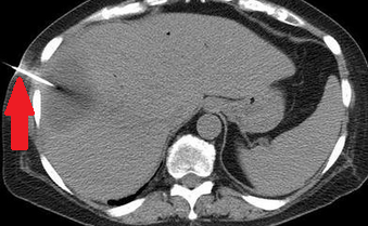 Figure 5.Percutaneous drainage of hepatic abscess.(Courtesy Dr.V.Penopoulos).