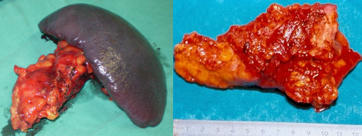 Figure 2.Pancreatic tail carcinomas.(Courtesy Dr.V.Penopoulos).