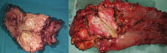Figure 1.Pancreatic head carcinomas.(Courtesy Dr.V.Penopoulos).