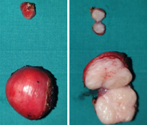 Figure 10.Enucleated uterine fibroids.(Courtesy Dr. V. Penopoulos). 2