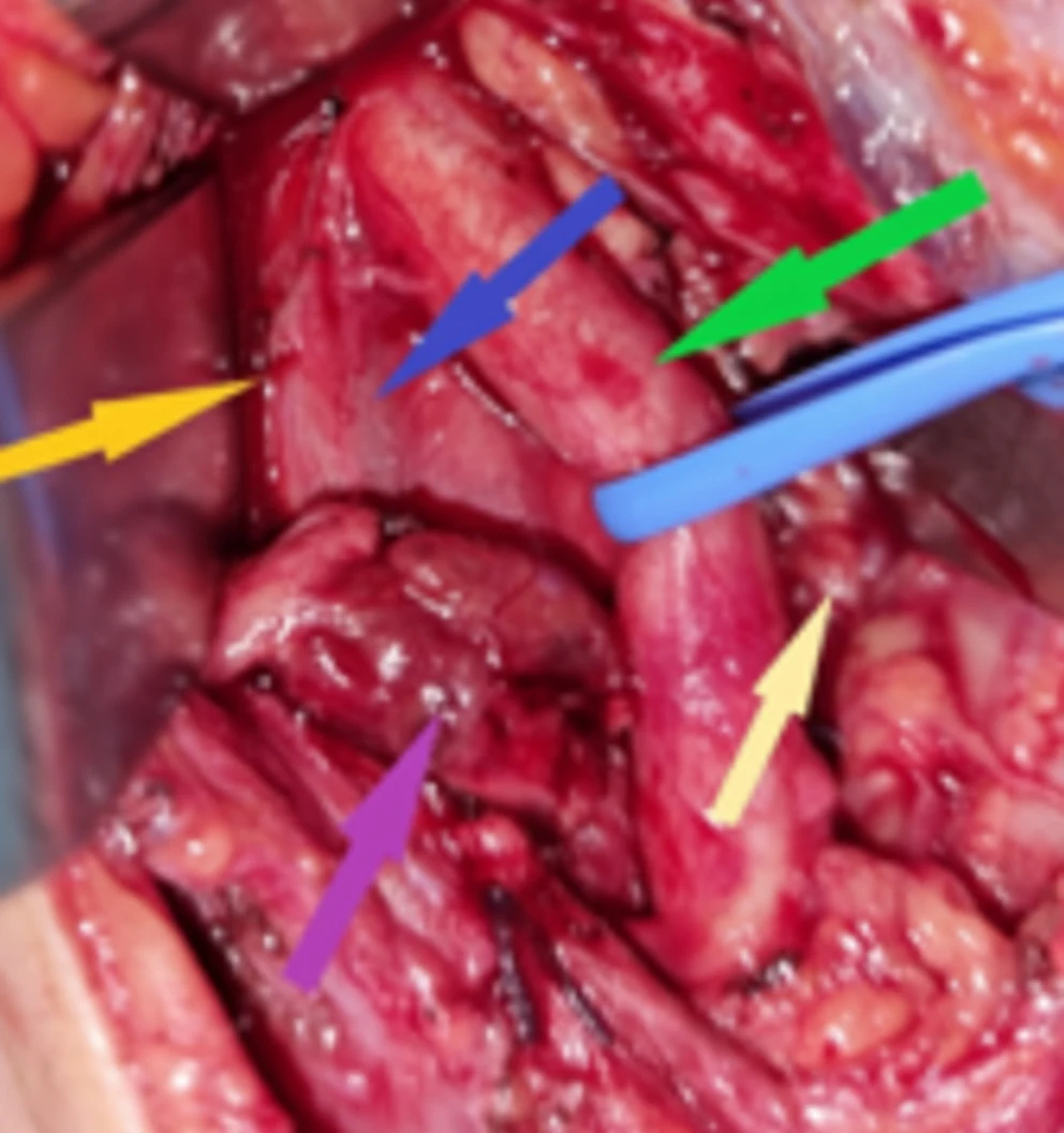 Ectopic Parathyroid Adenoma within the Carotid Sheath.
